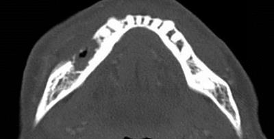 Case Report: Development of medication-related osteonecrosis of the jaw in a patient on long-term infliximab therapy